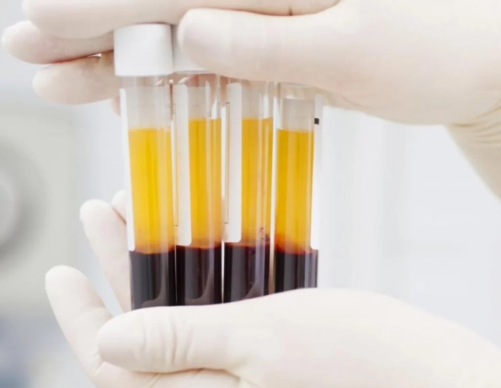 Todo lo que necesitas saber sobre el plasma rico en plaquetas